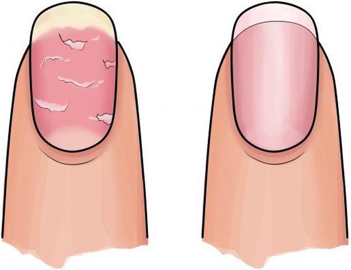 Herome Essential Set Na Kunstnagels Of Medicijngebruik